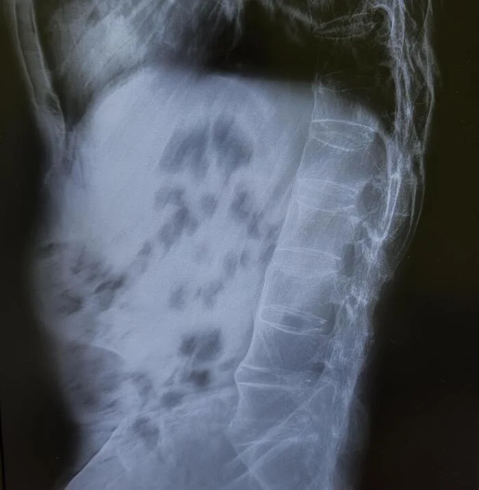 Ankylosing spondylitis (Bechterew's disease) - My, The medicine, Army, Research, X-ray, Radiology, Military enlistment office, Rheumatology, Bechterew's disease, Diagnostics, Assistance to conscripts, Ankylosing spondylitis, Spine, Disease, Longpost