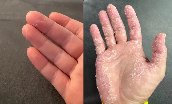Seasonal Shedding or Disease? Exfoliative Keratolysis - My, The medicine, Disease, Disease history, Body check, Longpost, Doctors, Problem skin, Leather, Dermatology, Kvd, Treatment, Genetic diseases