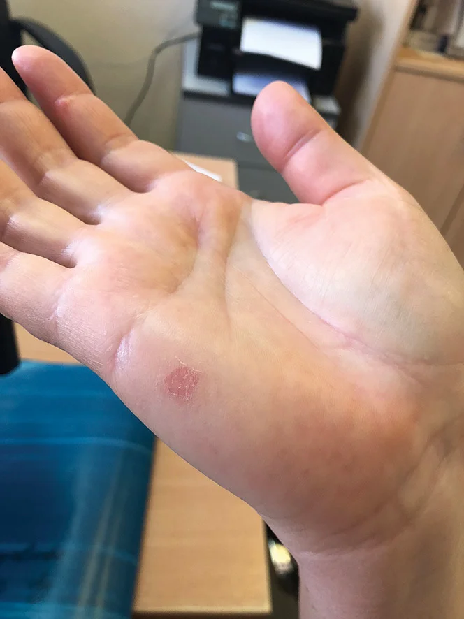 Seasonal Shedding or Disease? Exfoliative Keratolysis - My, The medicine, Disease, Disease history, Body check, Longpost, Doctors, Problem skin, Leather, Dermatology, Kvd, Treatment, Genetic diseases