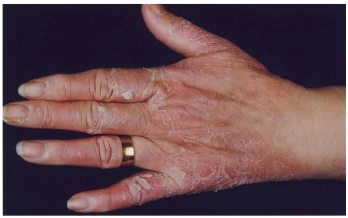 Seasonal Shedding or Disease? Exfoliative Keratolysis - My, The medicine, Disease, Disease history, Body check, Longpost, Doctors, Problem skin, Leather, Dermatology, Kvd, Treatment, Genetic diseases