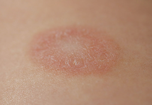 Фото из интернета. Так выглядит кошачий лишай у человека. Характерная бляшка в виде округлого пятна с "валиком".