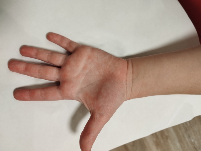 Ладонь руки с покраснением