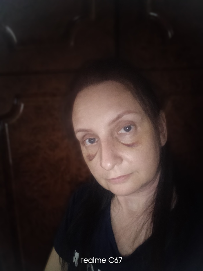 Продолжение 3:септопластика первый и последний день