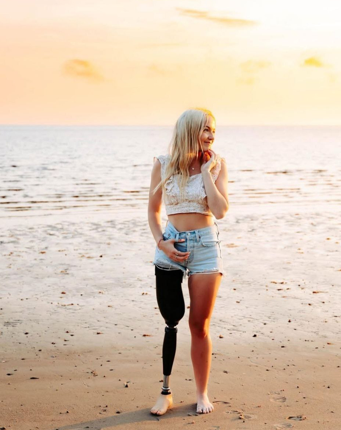 Вскоре после операции Эдиссон поставили протез. 3 года спустя она выглядит так