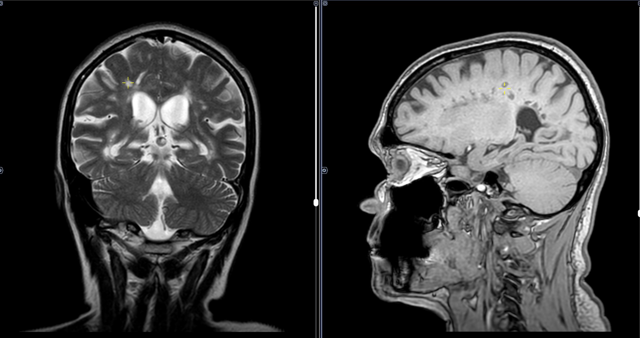 MRI-Multiple Sclerosis - Series MRI, My, The medicine, Army, Disease, Diagnostics, MRI, Multiple sclerosis, Military enlistment office, Neurology, Video, Soundless, Short videos, Longpost