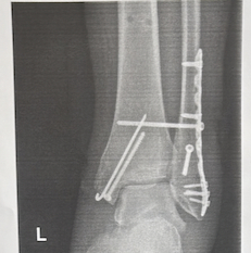Учусь ходить по-новому, йохохо Травма, Перелом, Костыли, Длиннопост
