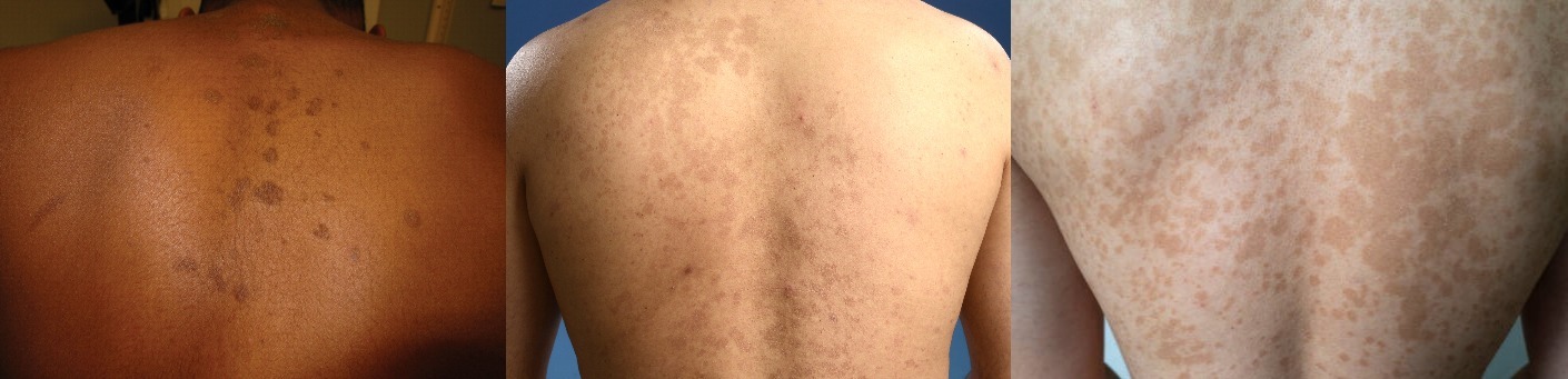 Fungal Spots - Versicolor Lichen - My, Problem skin, Dermatology, Fungus, The medicine, Medications, Stains, Longpost