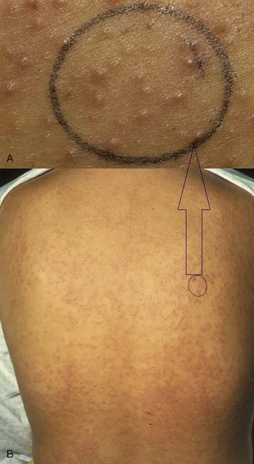 Poplar fluff, heat, prickly heat - Series Diseases of the skin appendages, My, The medicine, Leather, Health, Sweat, Dermatology, Dermatitis, Hyperhidrosis, sweating, Longpost