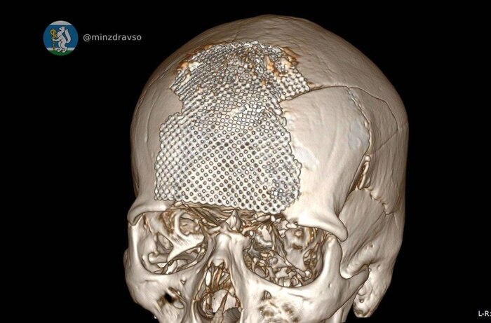 Врачи в Екатеринбурге собрали череп офицеру после тяжёлого ранения в зоне СВО