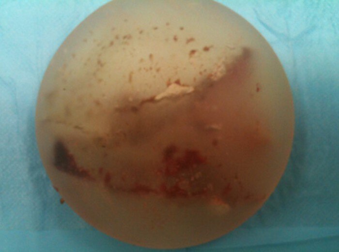 Figure 4. Фотография импланта после эксплантации. Можно увидеть присутствие крови и пузырьков воздуха в силиконовом геле после инъекций.