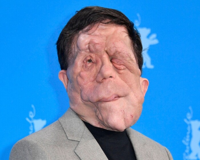 Серьезные аномалии лица, вызванные нейрофиброматозом типа 1, с множественными опухолями, приводящими к полной асимметрии, деформированным щекам и челюсти, а также отсутствию гармоничных пропорций, далеким от усредненного идеала.