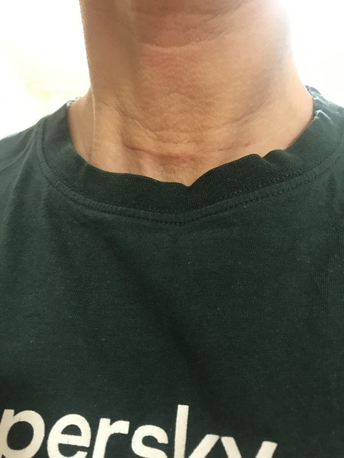 Настроение после гемитиреоидэктомии (удаление доли щитовидной железы) 2