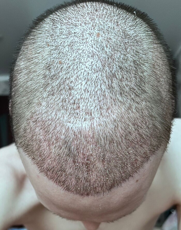 Пересадка волос: показываем результат сразу после