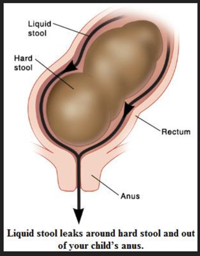 Чем опасен "безобидный" запор?