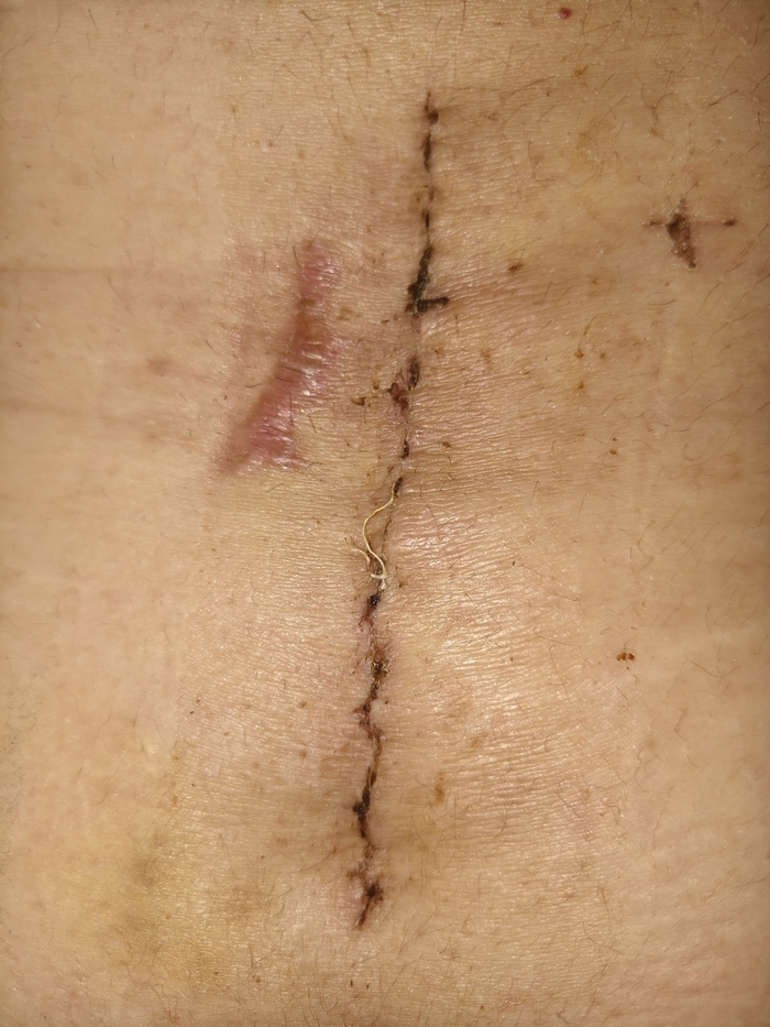 Красиво зашили в этот раз.