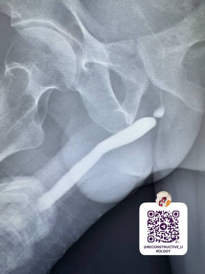 Посттравматическая стриктура уретры. Травма промежности от 2012 г