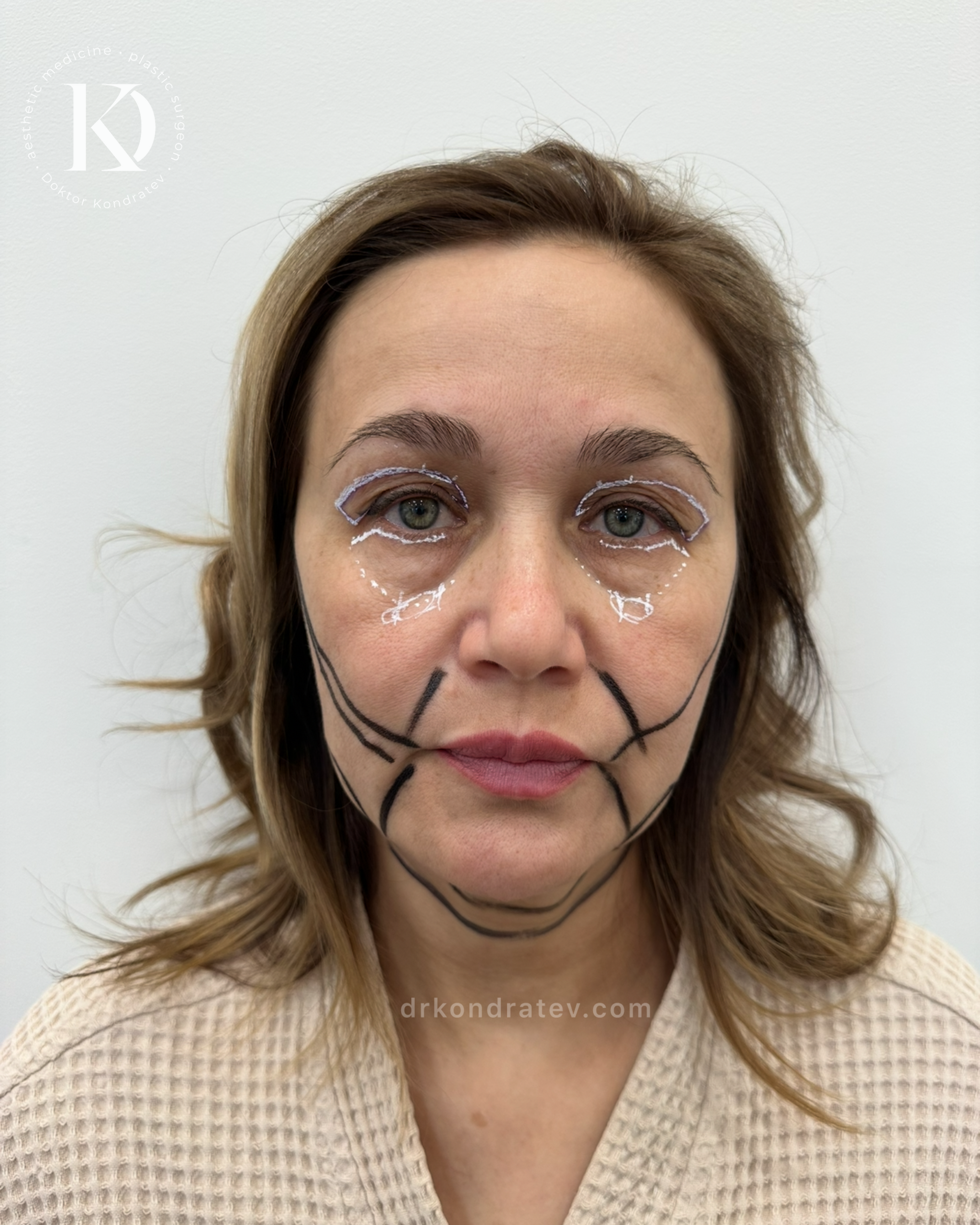How to restore your original face without signs of overtightening? - My, Face, Facelift, Blepharoplasty, Video, Vertical video, Short videos, Longpost
