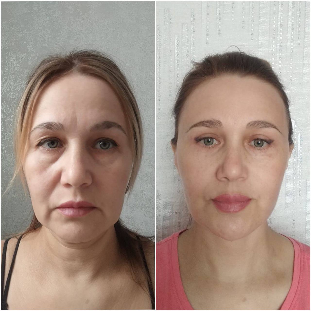 How to restore your original face without signs of overtightening? - My, Face, Facelift, Blepharoplasty, Video, Vertical video, Short videos, Longpost