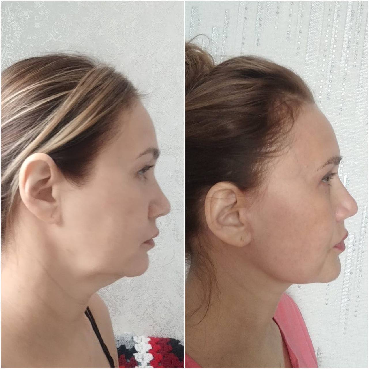 How to restore your original face without signs of overtightening? - My, Face, Facelift, Blepharoplasty, Video, Vertical video, Short videos, Longpost
