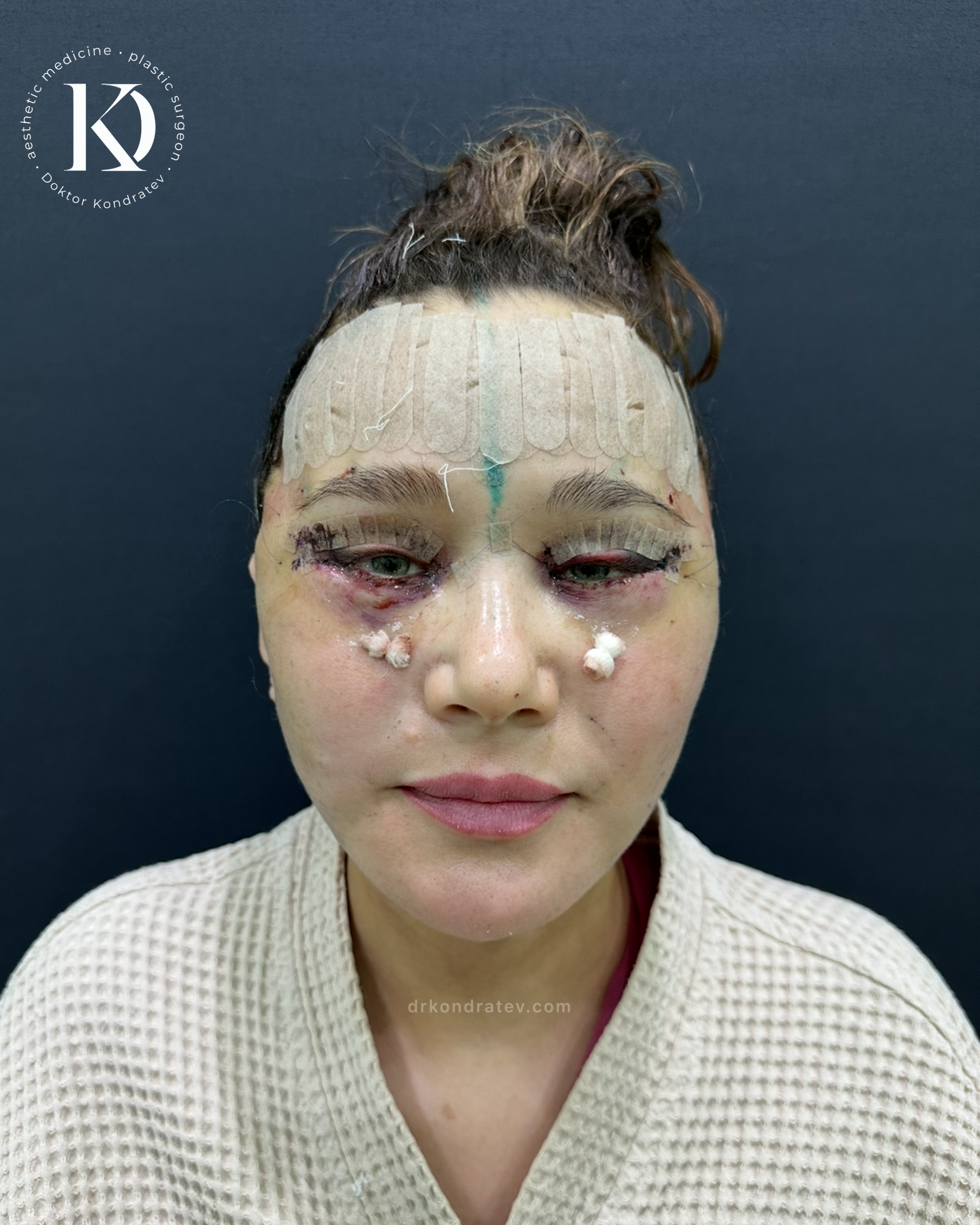 How to restore your original face without signs of overtightening? - My, Face, Facelift, Blepharoplasty, Video, Vertical video, Short videos, Longpost