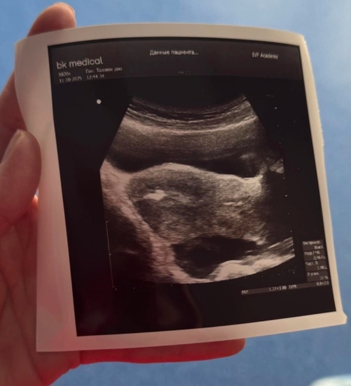 Целая баталия развернулась: рожать от донора или от мужчины?