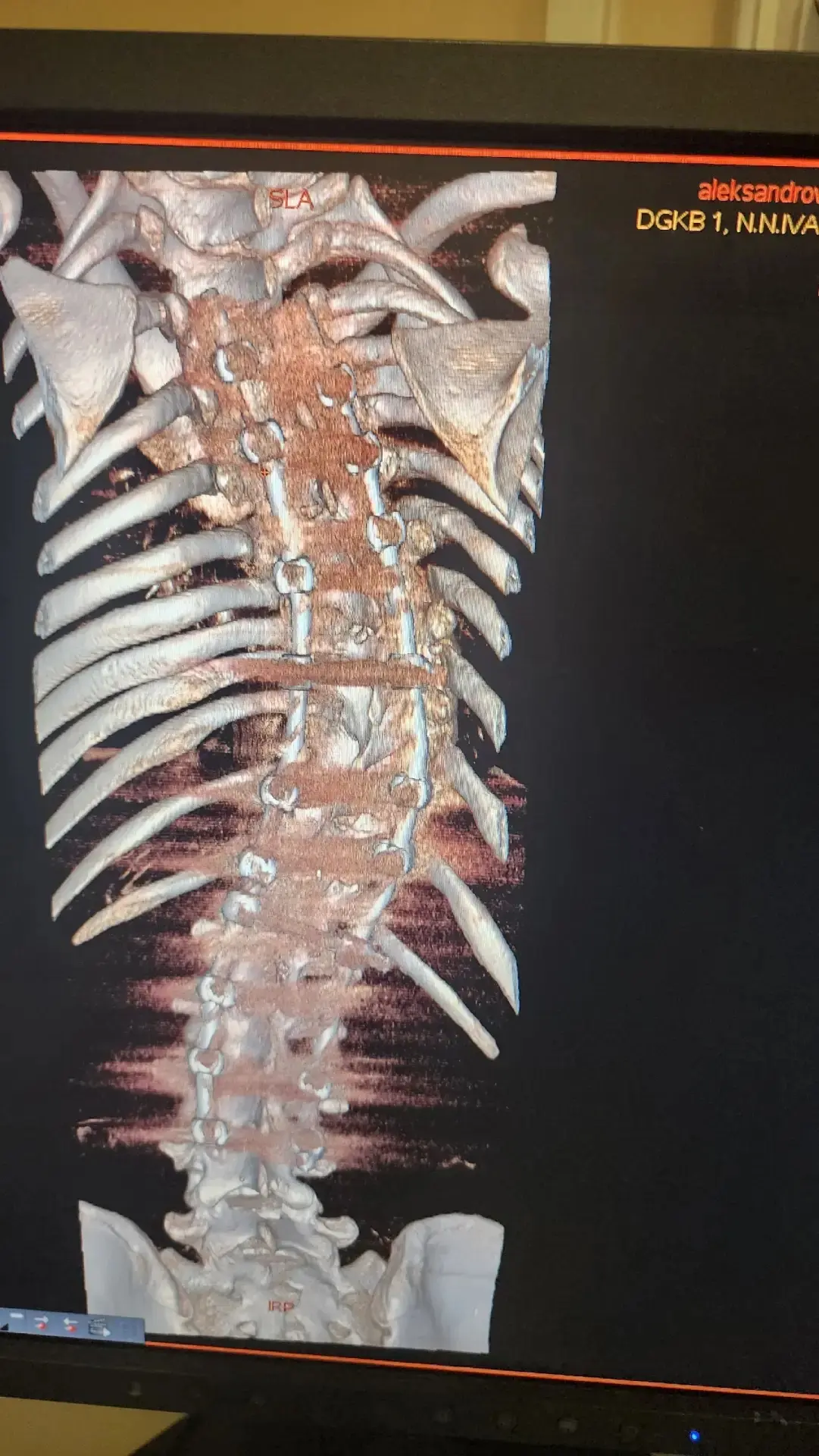 Samara doctors performed a complex operation on a teenager during a missile threat. - My, Operation, Negative, Scoliosis, The medicine, Surgery, Treatment