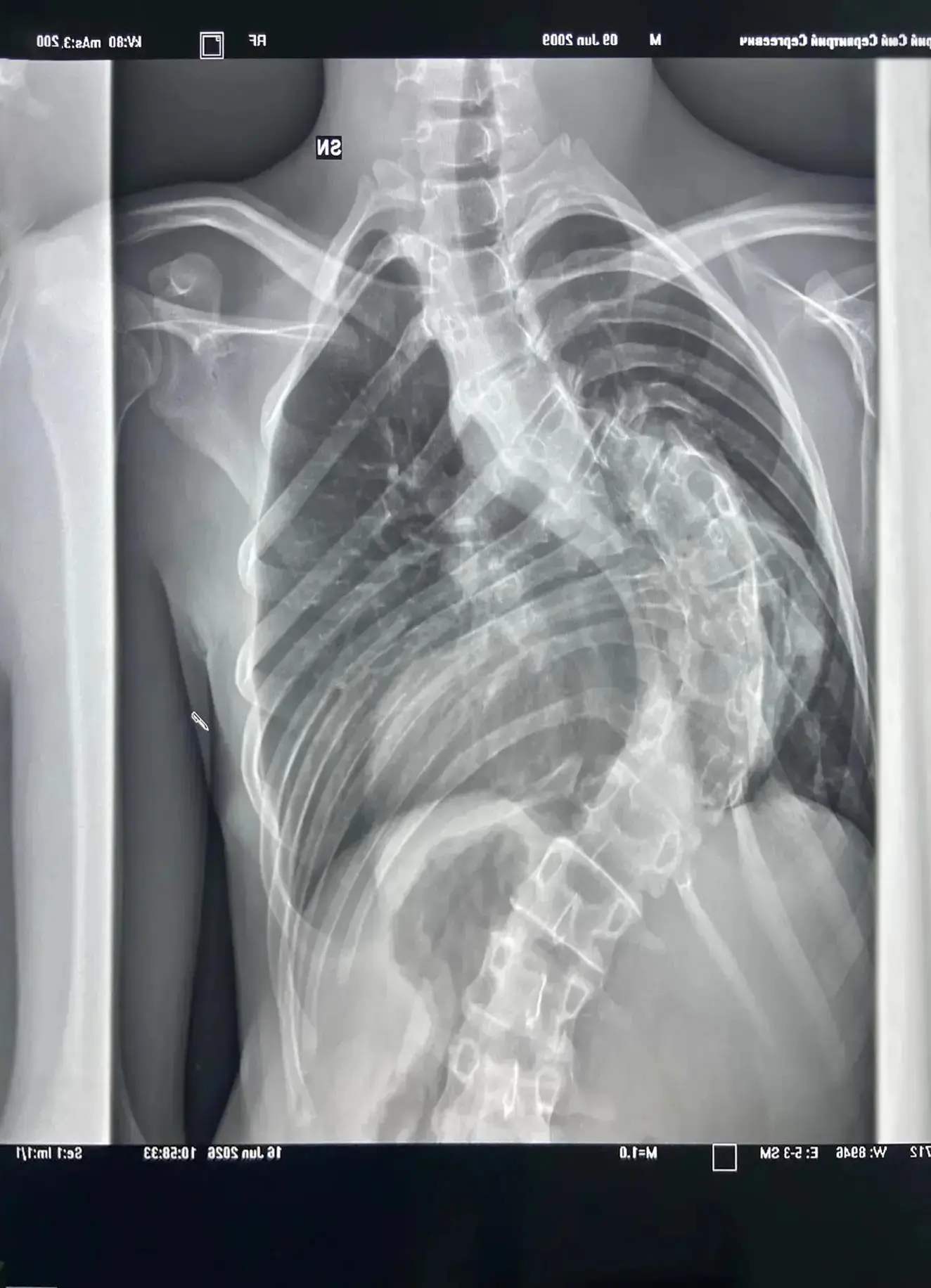 Samara doctors performed a complex operation on a teenager during a missile threat. - My, Operation, Negative, Scoliosis, The medicine, Surgery, Treatment