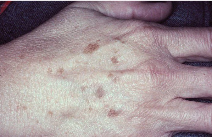 Take care of your skin from a young age - My, Nauchpop, The sun, Tan, Leather, Disease, Dermatology, Health, Mutation, Longpost