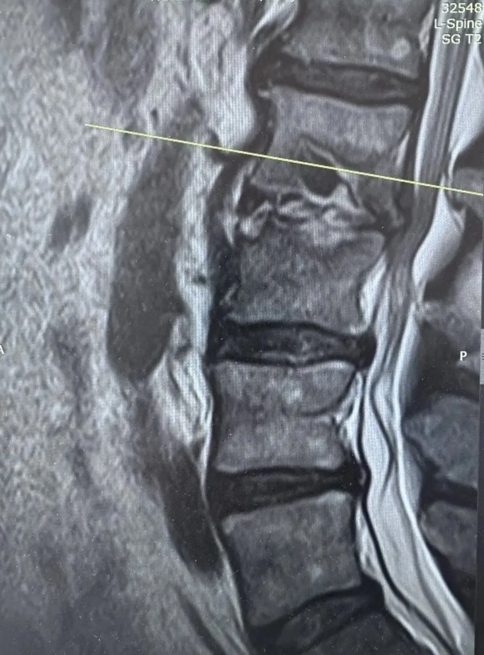 In Krasnoyarsk, doctors saved a man whose stomach was pierced by a chair leg, injuring his spine. - My, Negative, Injury, Operation
