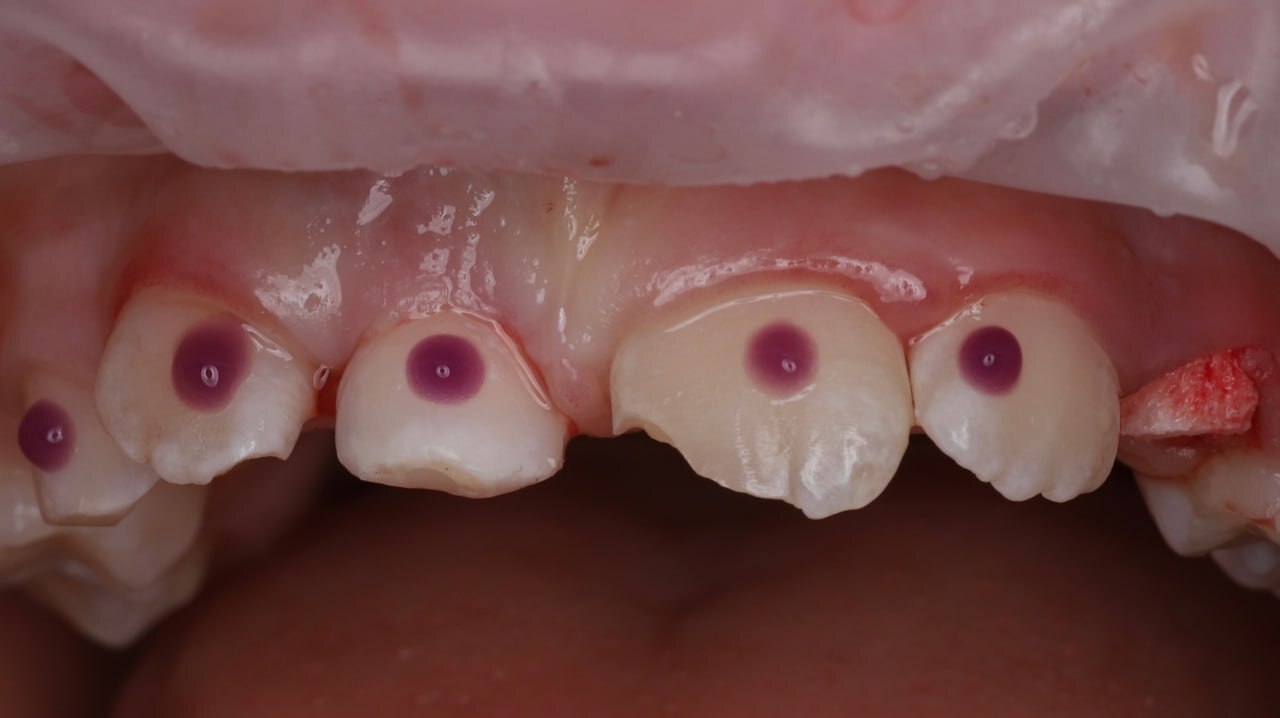 An 8-year-old female patient was referred by a colleague from St. Petersburg. - Dentistry, Teeth, Doctors, Health