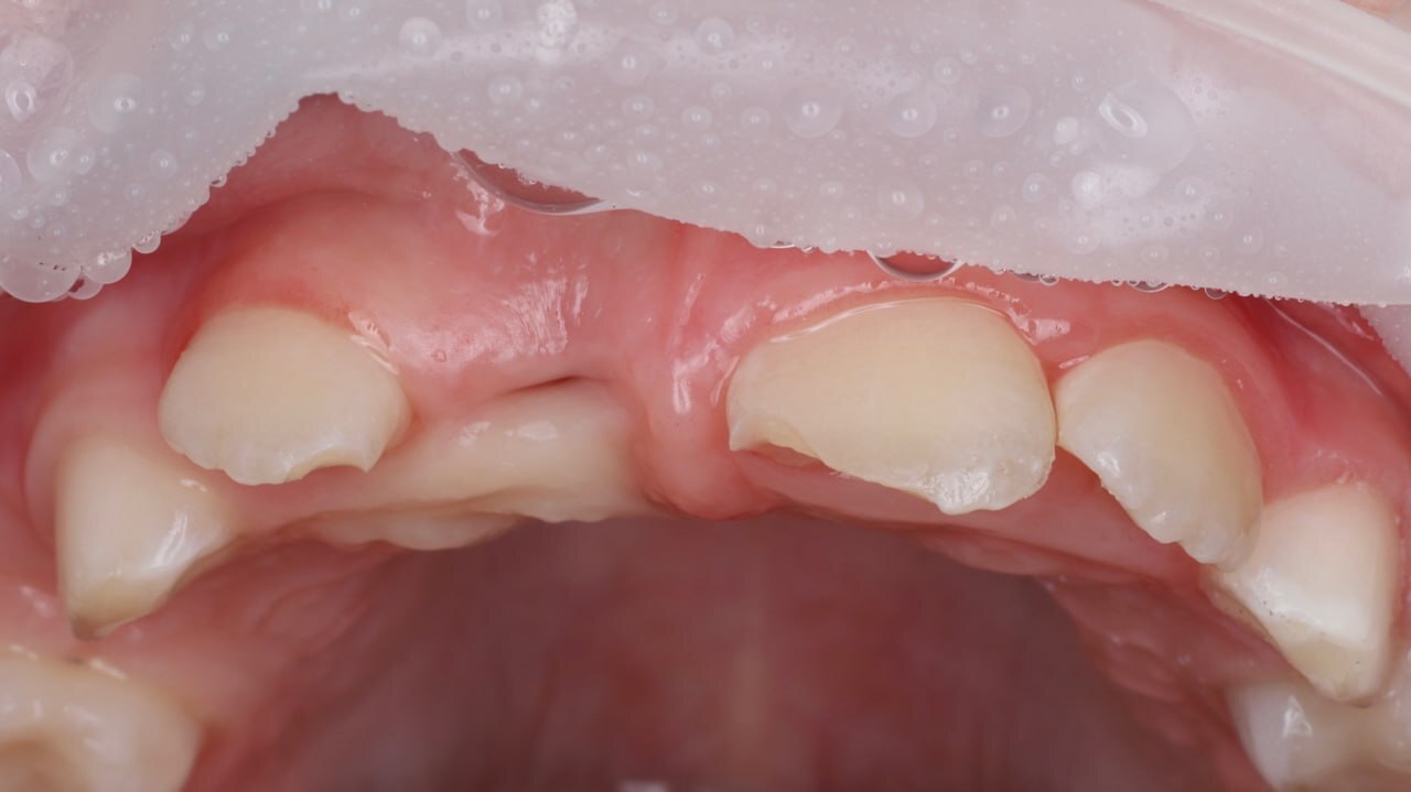 An 8-year-old female patient was referred by a colleague from St. Petersburg. - Dentistry, Teeth, Doctors, Health