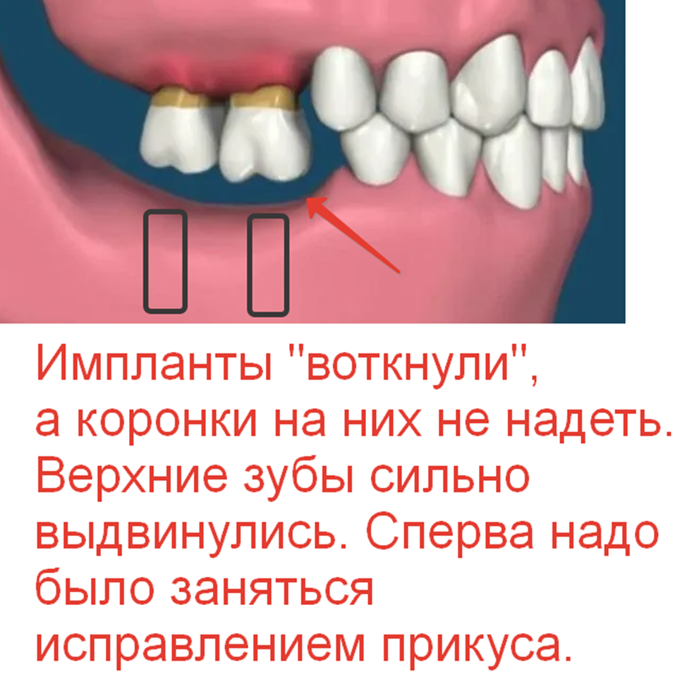 The Saga of Dentistry. Chapter 136. Why is it better to extract a tooth with thin root walls than to restore it with a crown? - Series The saga of dentistry, My, Dentistry, The medicine, Health, Doctors, Teeth, Dentist, Extraction of teeth, Crown, The patients, Medics, Surgery, Work, Longpost