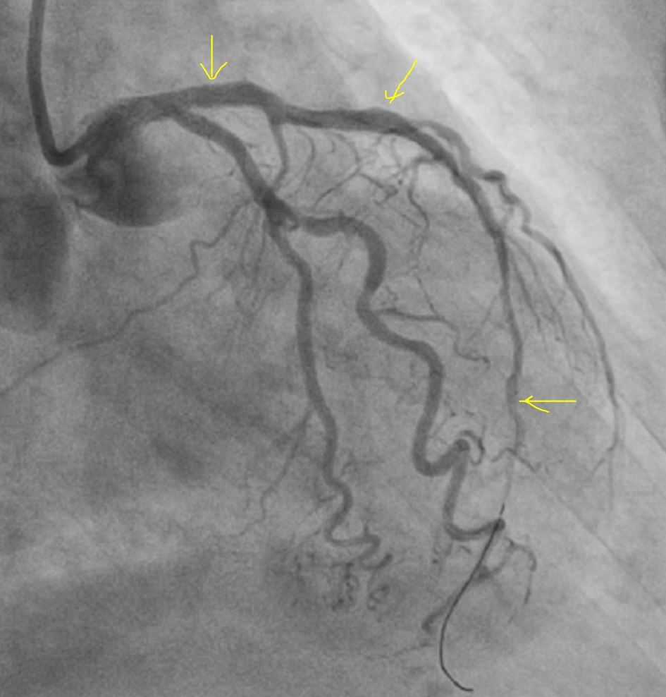 Heart attack at 95 years old - Series Clinical cases, My, The medicine, Heart attack, Age, Hospital, Stent, Video, Soundless, Short videos, Longpost