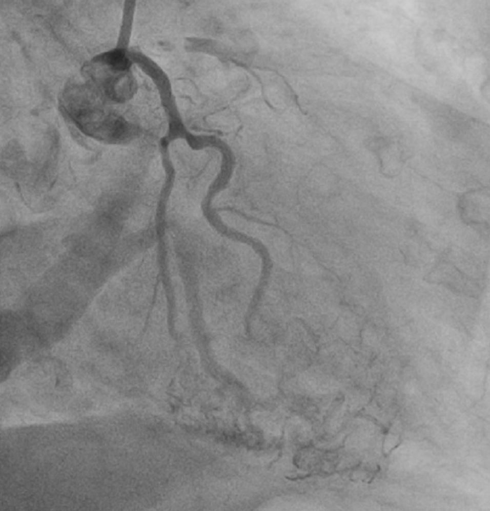 Heart attack at 95 years old - Series Clinical cases, My, The medicine, Heart attack, Age, Hospital, Stent, Video, Soundless, Short videos, Longpost