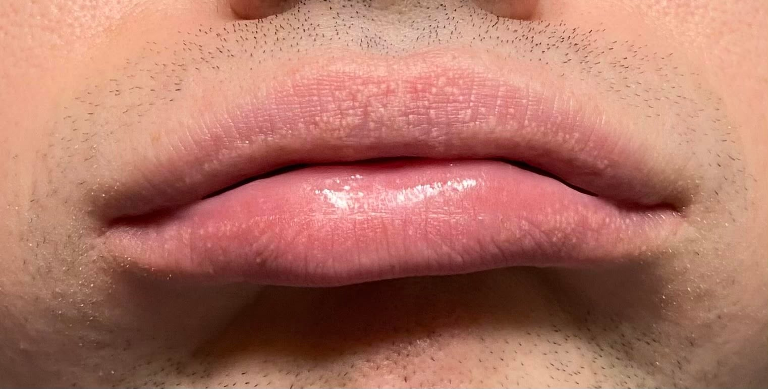 Semolina on the lips and beyond - Fordyce granules - Series This is the norm, My, Health, Dermatology, Fordyce granules, Cosmetology, This is the norm, Problem skin, Treatment, Kvd, Longpost